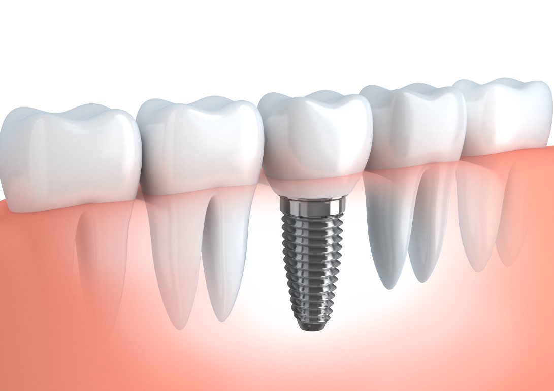 dental-implant-1