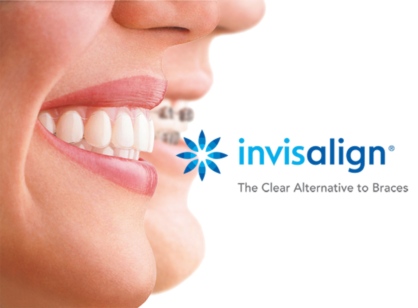 invisalign image-2