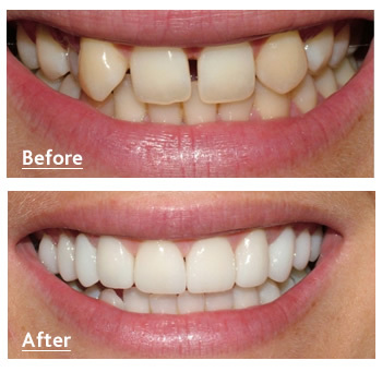 veneers-before-after