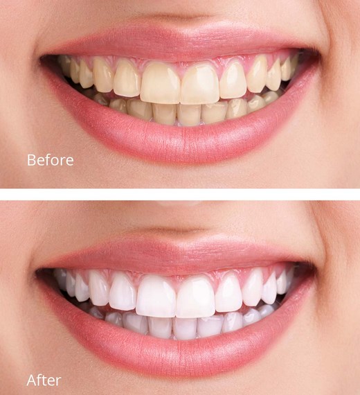 whitening-before-after