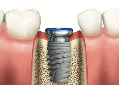 FREE Dental Implant - From $999